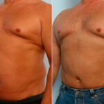 Male Liposuction before and after photos in Houston, TX, Patient 28894