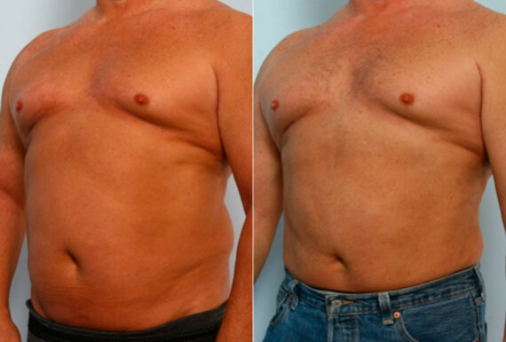 Male Liposuction before and after photos in Houston, TX, Patient 28894