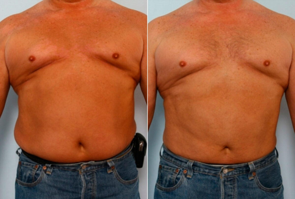 Male Liposuction before and after photos in Houston, TX, Patient 28894