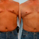 Male Liposuction before and after photos in Houston, TX, Patient 28894