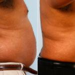 Male Liposuction before and after photos in Houston, TX, Patient 28899