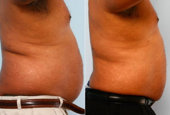 Male Liposuction before and after photos in Houston, TX, Patient 28899