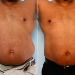 Male Liposuction before and after photos in Houston, TX, Patient 28899