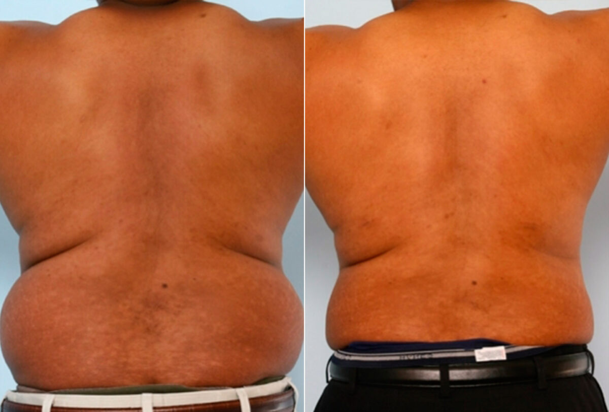 Male Liposuction before and after photos in Houston, TX, Patient 28899