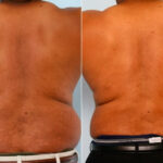 Male Liposuction before and after photos in Houston, TX, Patient 28899