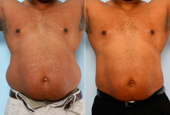 Male Liposuction before and after photos in Houston, TX, Patient 28899