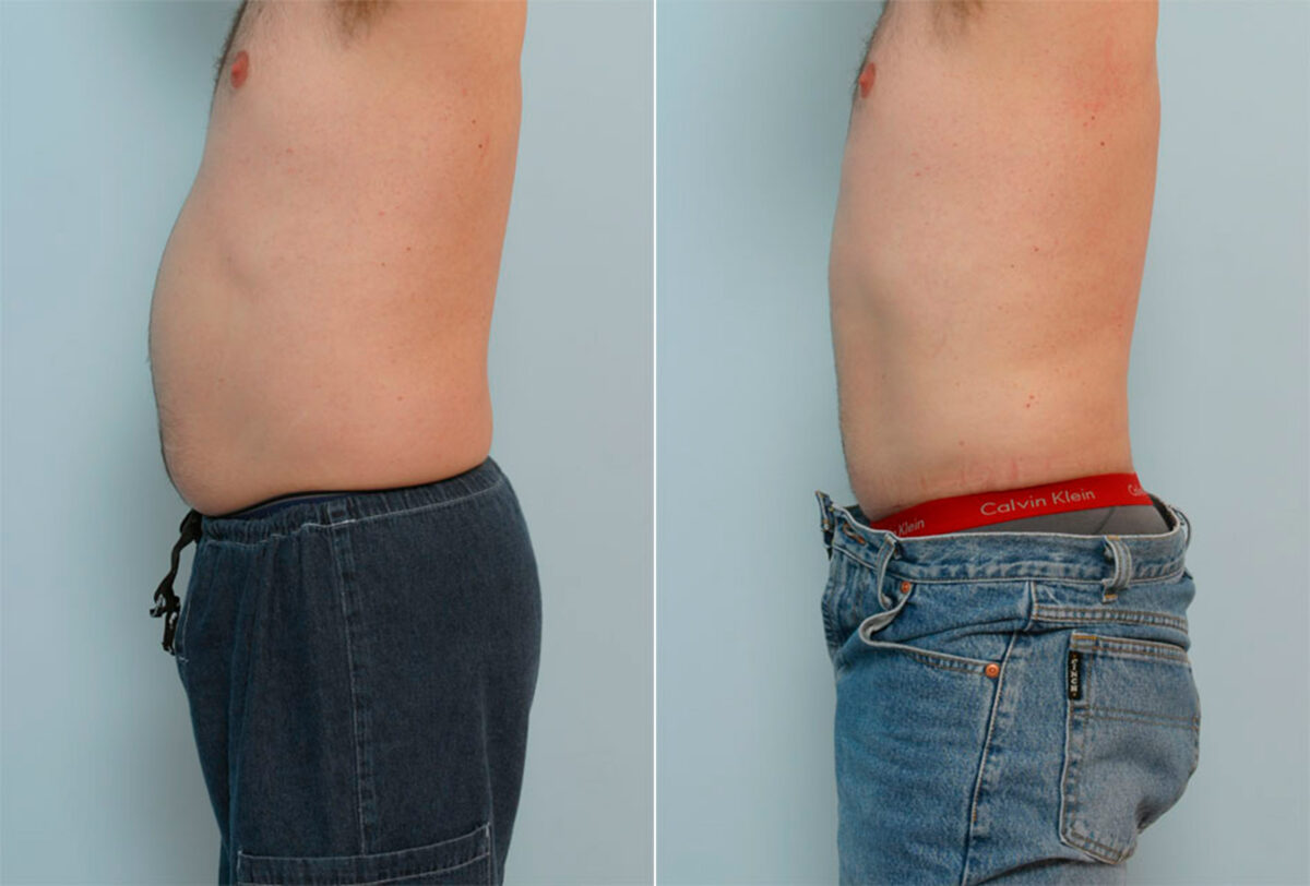 Male Liposuction before and after photos in Houston, TX, Patient 29087