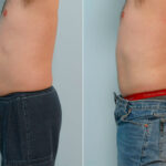 Male Liposuction before and after photos in Houston, TX, Patient 29087