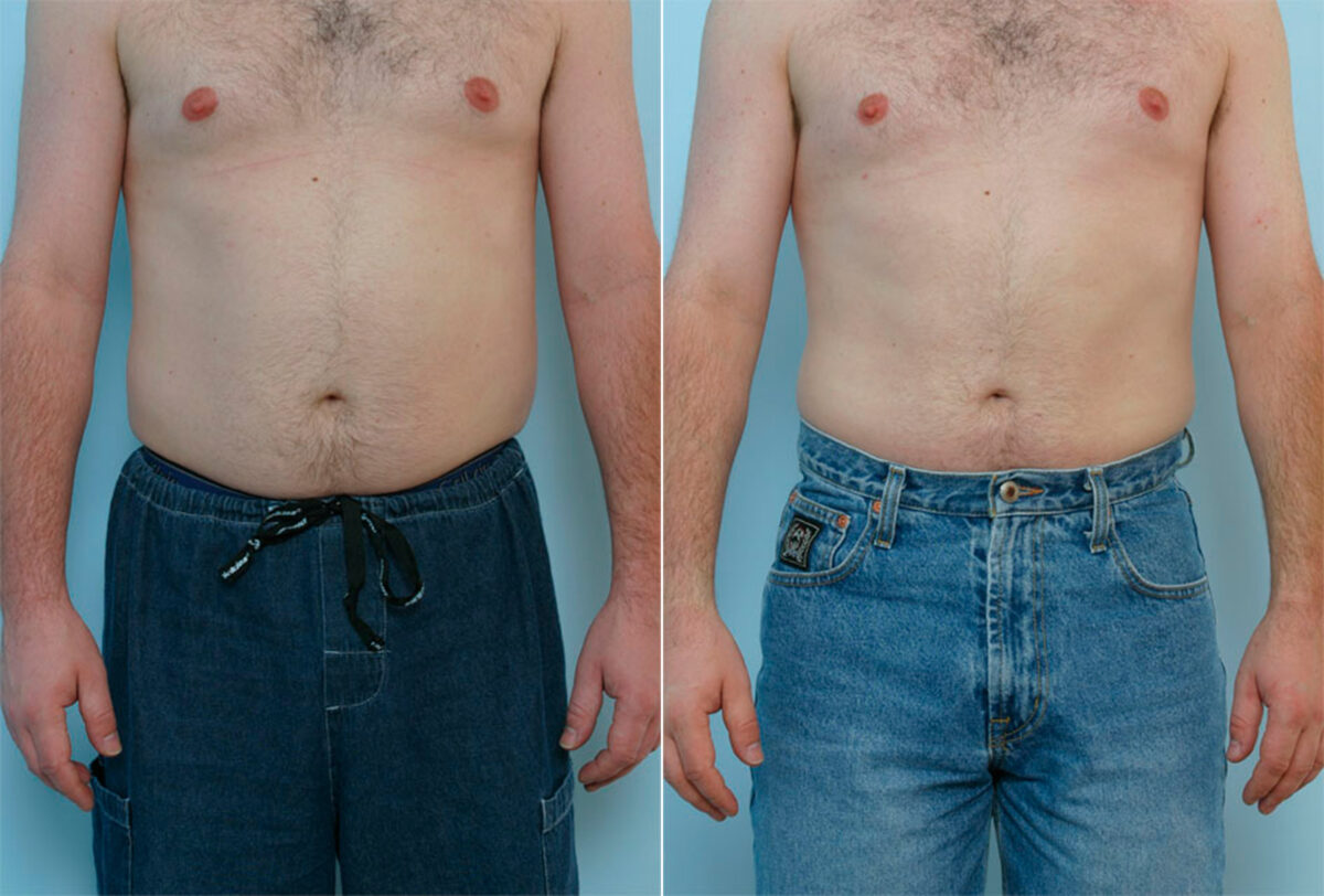 Male Liposuction before and after photos in Houston, TX, Patient 29087
