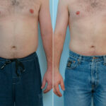 Male Liposuction before and after photos in Houston, TX, Patient 29087