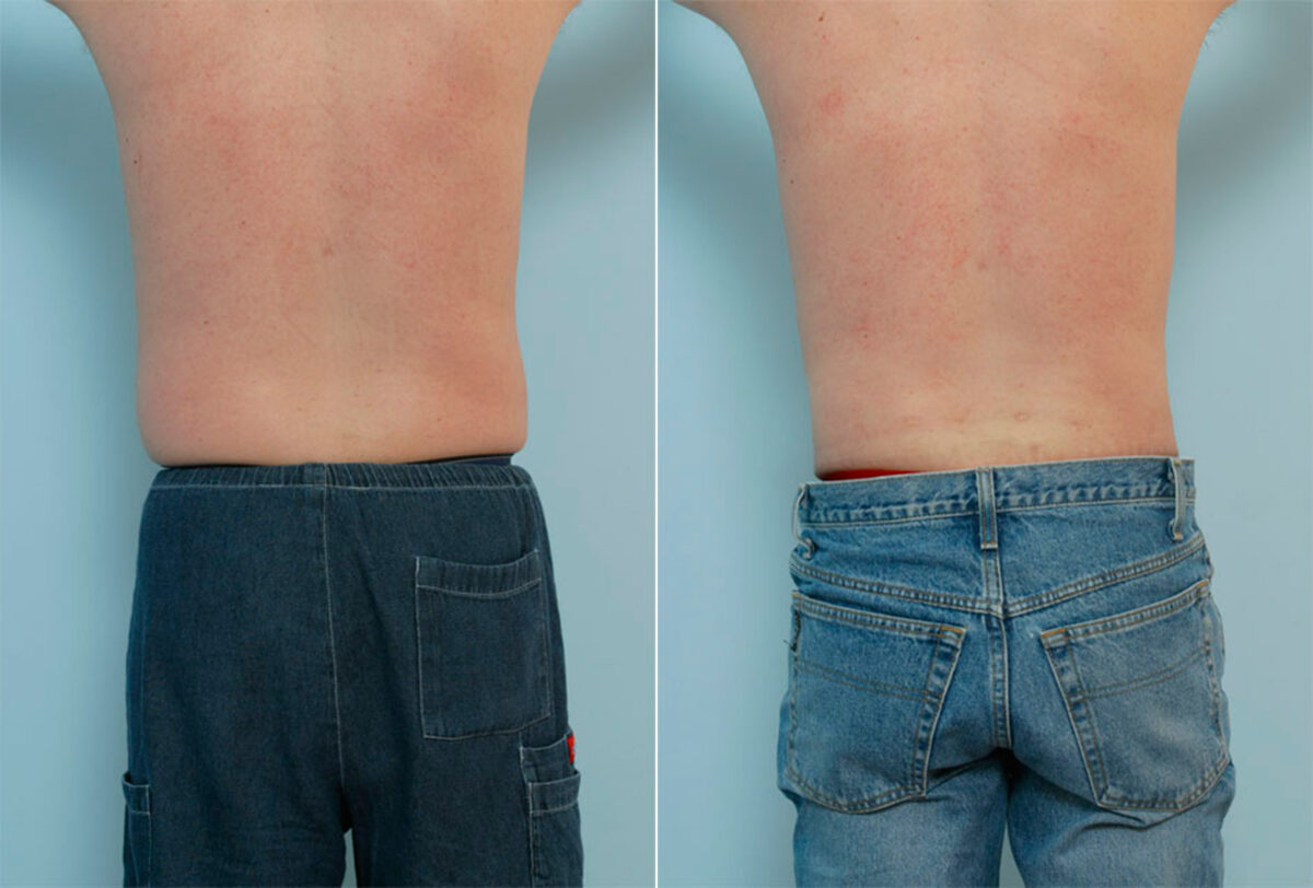 Male Liposuction before and after photos in Houston, TX, Patient 29087