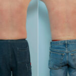 Male Liposuction before and after photos in Houston, TX, Patient 29087