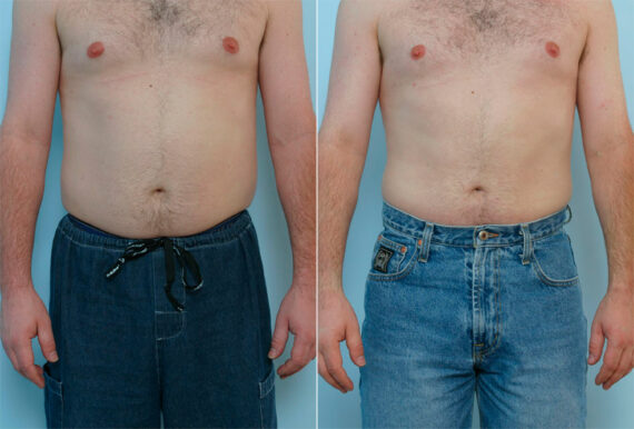 Male Liposuction before and after photos in Houston, TX, Patient 29087