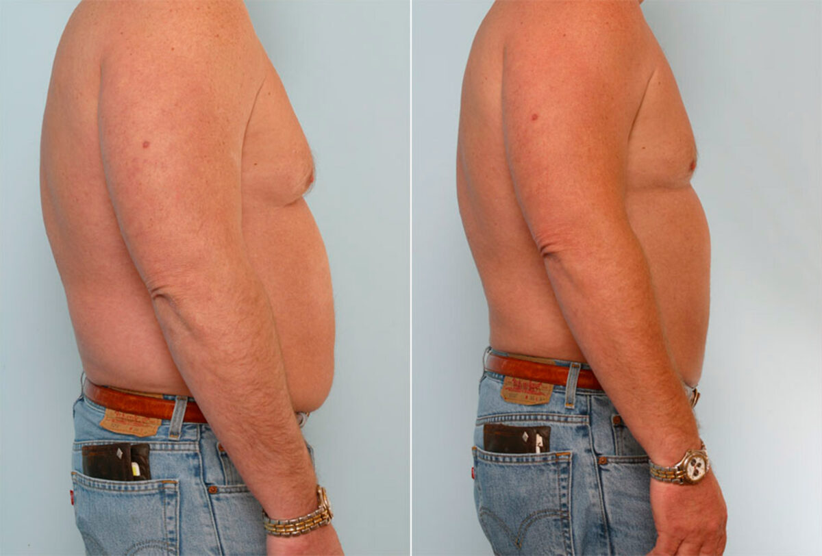 Male Liposuction Photos, Houston, Tx