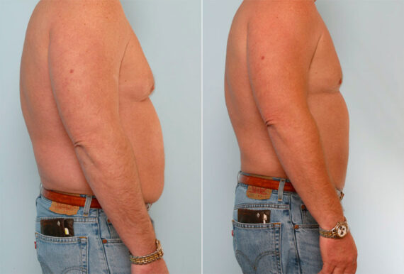 Male Liposuction before and after photos in Houston, TX, Patient 29122