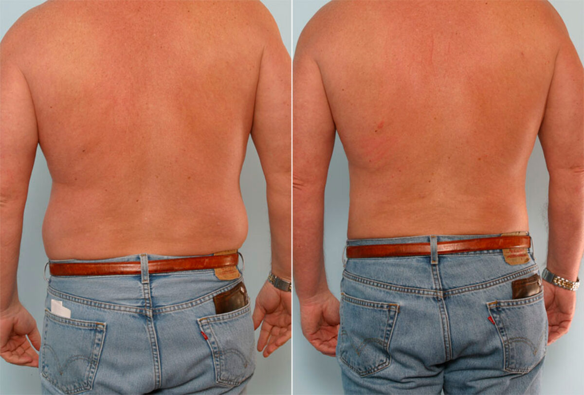 Liposuction for Men Before & After Photos Patient 149