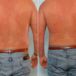 Male Liposuction before and after photos in Houston, TX, Patient 29122