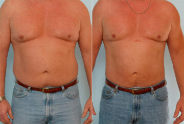 Male Liposuction before and after photos in Houston, TX, Patient 29122