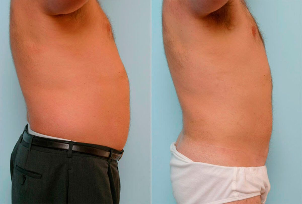 Male Liposuction before and after photos in Houston, TX, Patient 29154