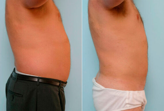 Male Liposuction before and after photos in Houston, TX, Patient 29154