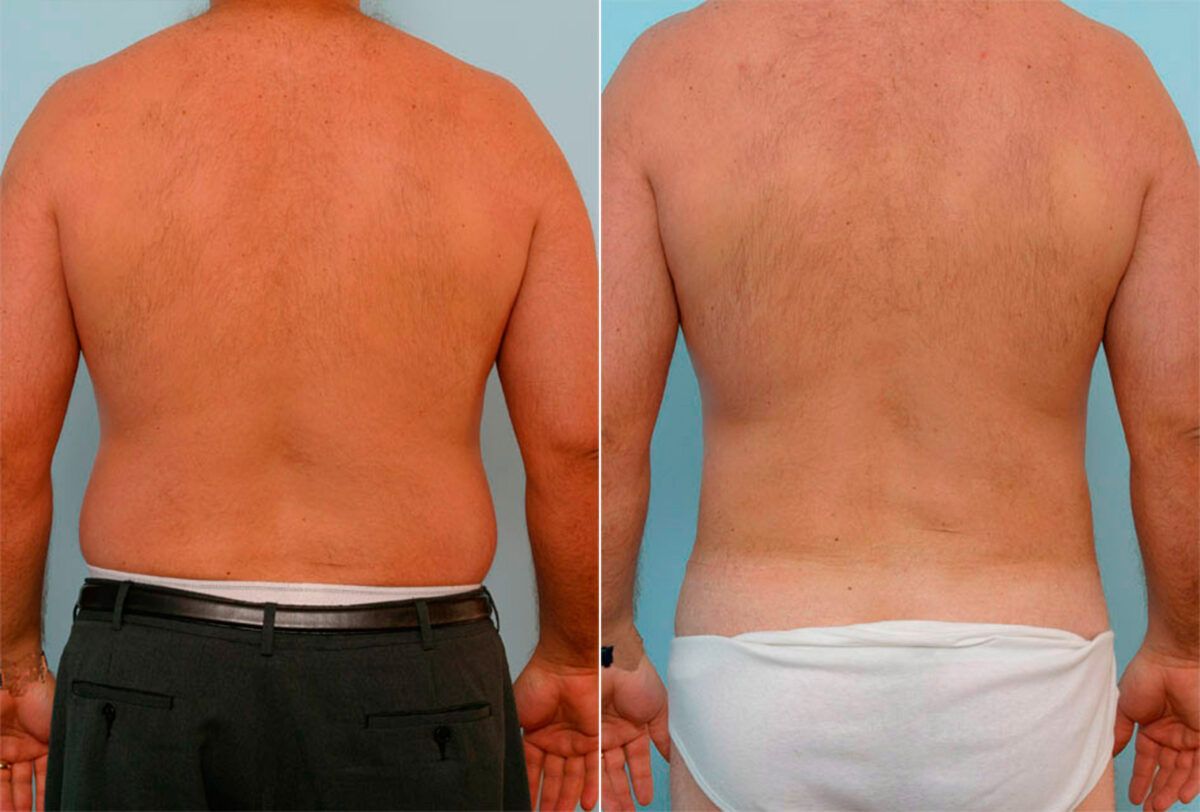 Male Liposuction before and after photos in Houston, TX, Patient 29154