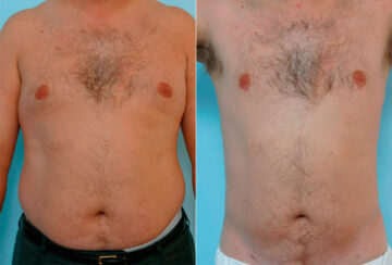 Male Liposuction before and after photos in Houston, TX, Patient 29154