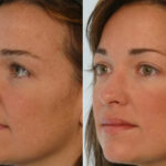 Radiesse before and after photos in Houston, TX, Patient 29400