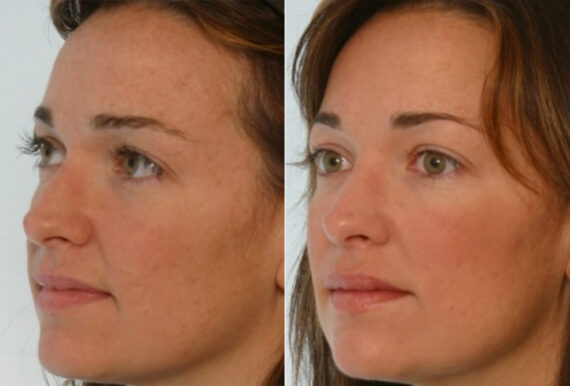 Radiesse before and after photos in Houston, TX, Patient 29400