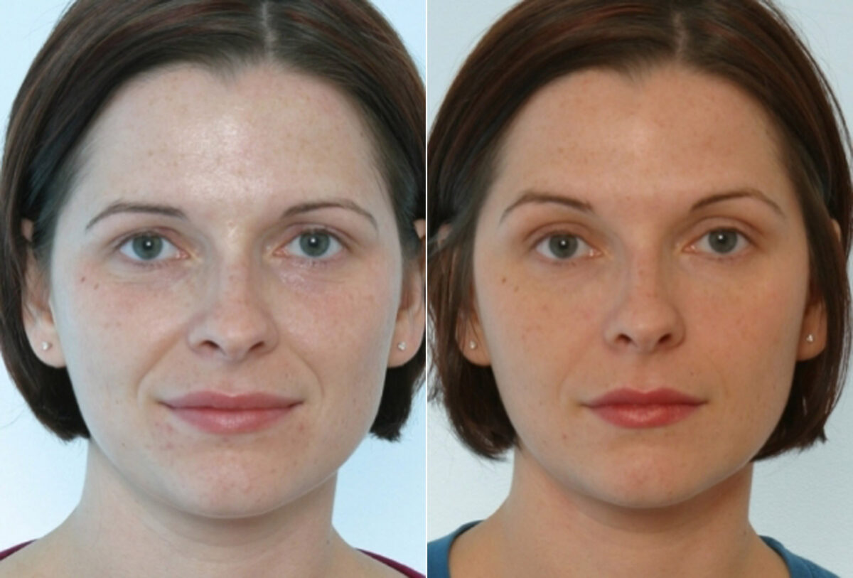 Radiesse before and after photos in Houston, TX, Patient 29403