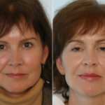 Radiesse before and after photos in Houston, TX, Patient 29406