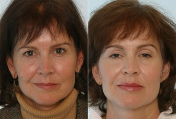 Radiesse before and after photos in Houston, TX, Patient 29406