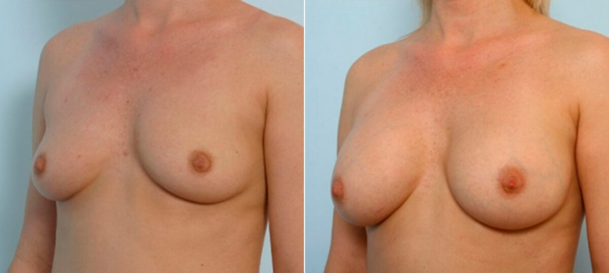 Breast Augmentation before and after photos in Houston, TX, Patient 34686