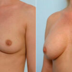 Breast Augmentation before and after photos in Houston, TX, Patient 34686