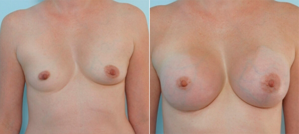 Breast Augmentation before and after photos in Houston, TX, Patient 34702