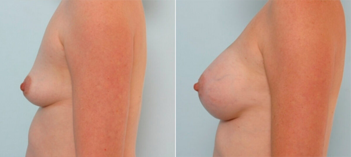 Breast Augmentation before and after photos in Houston, TX, Patient 34702