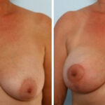 Breast Augmentation-Mastopexy before and after photos in Houston, TX, Patient 34718