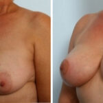 Breast Augmentation-Mastopexy before and after photos in Houston, TX, Patient 34718