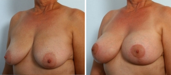 Breast Augmentation-Mastopexy before and after photos in Houston, TX, Patient 34718