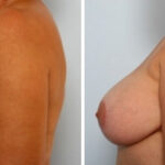 Breast Augmentation-Mastopexy before and after photos in Houston, TX, Patient 34718