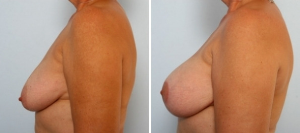 Breast Augmentation-Mastopexy before and after photos in Houston, TX, Patient 34718