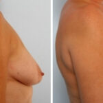 Breast Augmentation-Mastopexy before and after photos in Houston, TX, Patient 34718