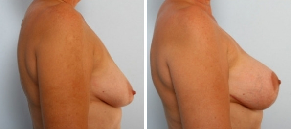 Breast Augmentation-Mastopexy before and after photos in Houston, TX, Patient 34718