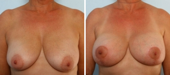 Breast Augmentation-Mastopexy before and after photos in Houston, TX, Patient 34718