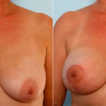 Breast Lift with Augmentation before and after photos in Houston, TX, Patient 34733