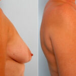 Breast Lift with Augmentation before and after photos in Houston, TX, Patient 34733