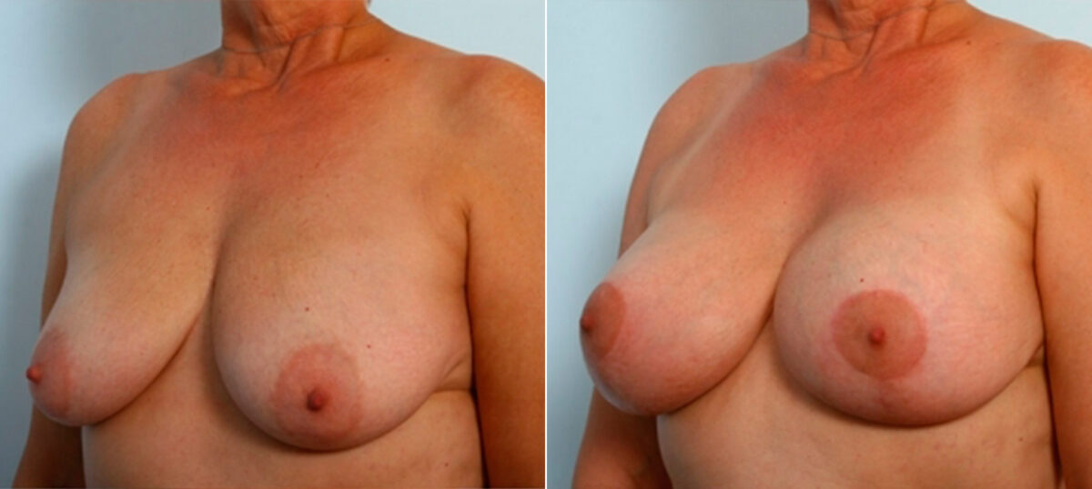 Breast Lift with Augmentation before and after photos in Houston, TX, Patient 34733