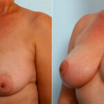 Breast Lift with Augmentation before and after photos in Houston, TX, Patient 34733