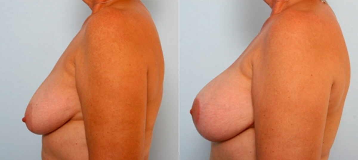 Breast Lift with Augmentation before and after photos in Houston, TX, Patient 34733