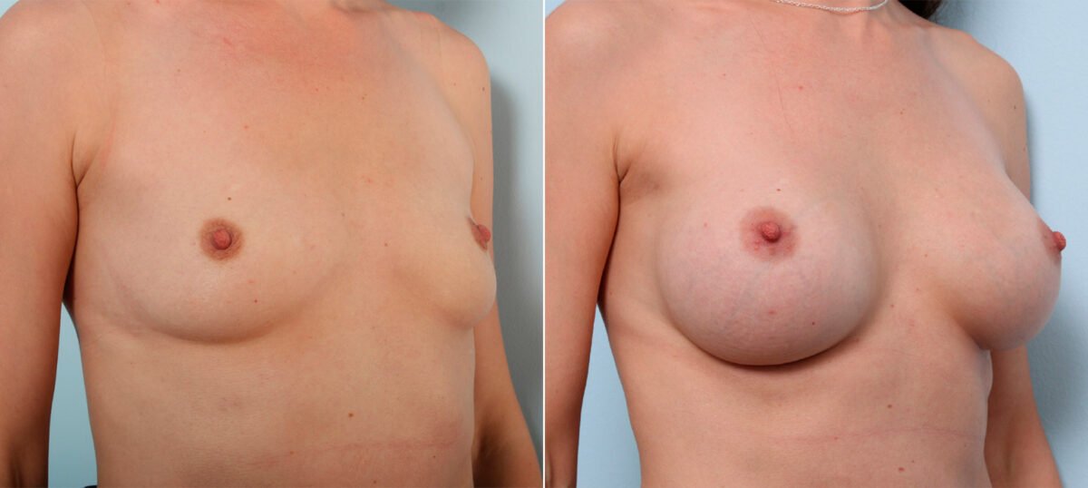 Breast Augmentation before and after photos in Houston, TX, Patient 41564