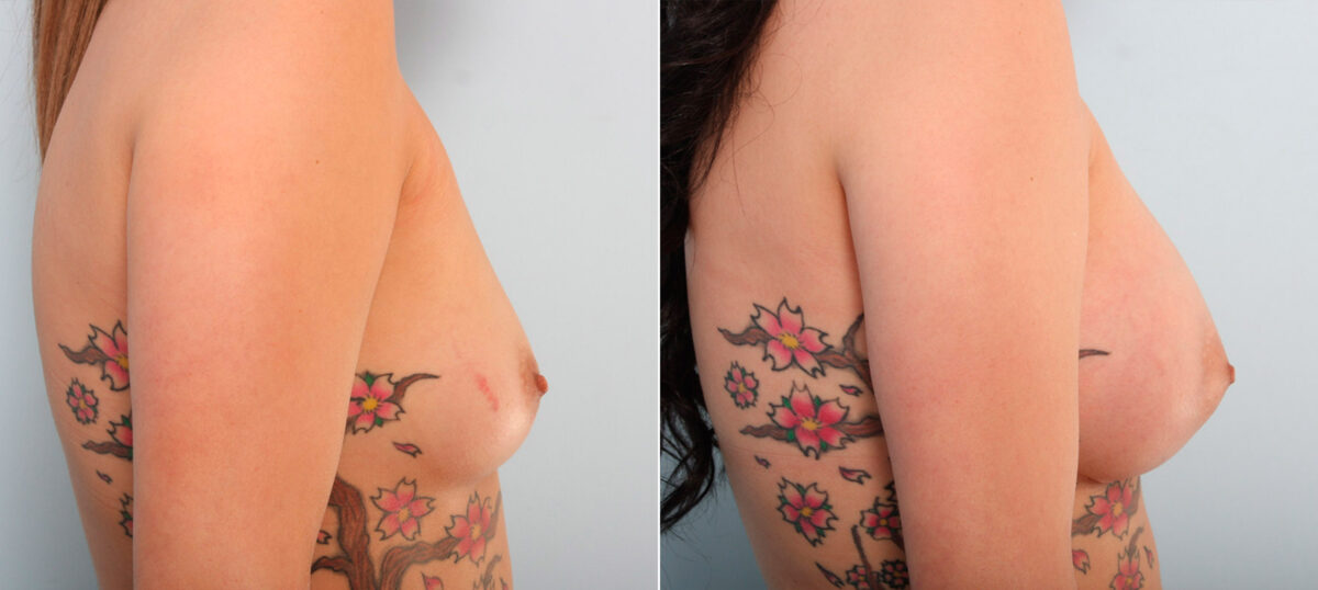 Breast Augmentation before and after photos in Houston, TX, Patient 41581